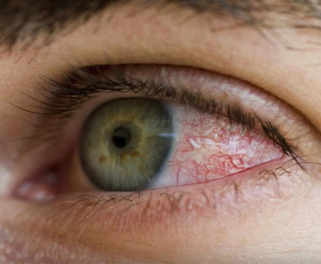Why Does Weed Make Our Eyes Red? And How Can You Clear Them Up?