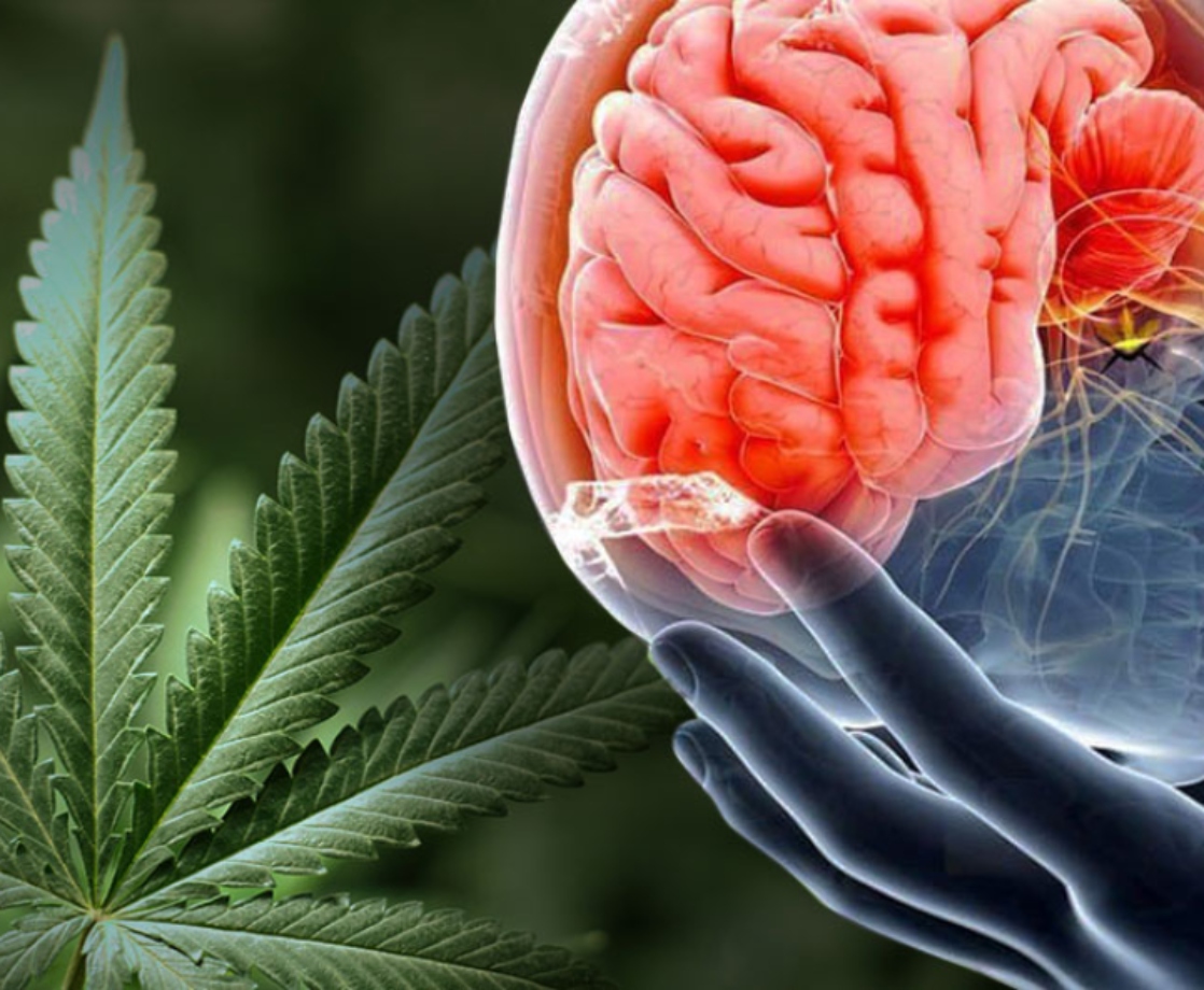 Nearly 1 in 3 People Who Get Migraines Medicate with Cannabis to Treat Pain, Survey Says